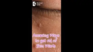 Amazing Ways to get rid of Skin Warts- Dr. Nischal K | Doctors' Circle #youtubeshorts #shorts