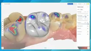 DS Core Plan Feature - CEREC on DS Core - Design Restoration