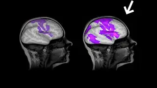 Normal Brain vs. Brain.fm Brain