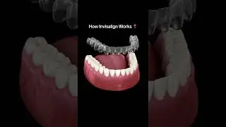 How Invisalign Works #dentist #dental #ortho #invisline #ytshhorts #denttalk