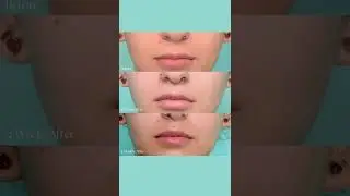 Lip Lift Surgery | Plastic Surgeon | Before And After