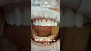 Fantastic dental veneers transformation without any effort at Dentatur #dentatur  #smiledesignturkey