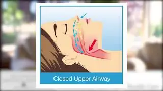 Relationship Between Child Sleep Apnea and Bed Wetting