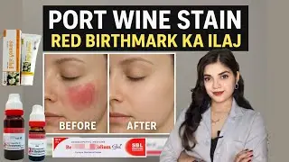 &ldquo;क्या Homeopathy से मिट सकता है जन्म से बना Port Wine Stain? | Red Birthmark Cure&rdquo;