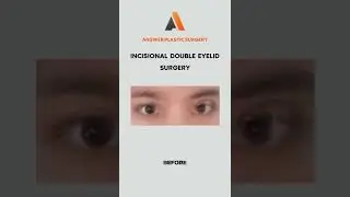 Incisional Double Eyelid Surgery | Answer Plastic Surgery #shorts #incisionaldoubleeyelidsurgery