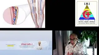 ماهي الدوالي وعلاجها بدون جراحه  الدكتور وليد سرحان استشاري امراض القلب في السويد