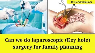 Can we do laparoscopic (Keyhole) surgery for family planning or other Gynac surgery