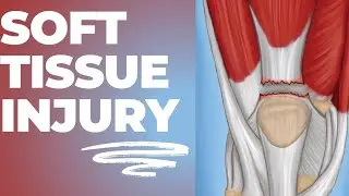 Supportive tissue injury| Soft tissue injury| muscle strain| sprain| tendonitis|dr.physioclasses