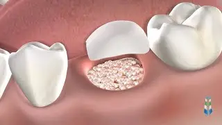 Bone Grafting & PRF in Springfield IL at Oral & Facial Surgeons of Illinois