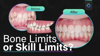 Invisalign&reg; Biomechanics Deep Dive: Adult Expansion Done Right - Ep. 21