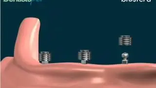 Protesi totale inferiore: la dentiera fissa