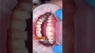 Best Veneers in Istanbul: The Elite Signature of a Flawless Smile ✨