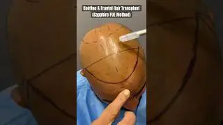 Hair line & Frontal Hair Transplant with Sapphire FUE Method at Cara Clinic Mumbai