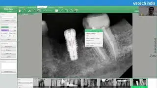 How to Calibrate  Length for Accurate Measurement in Vatech Software#vatech