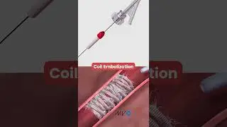 Что такое спиральная эмболизация? | Анимированное медицинское объяснение