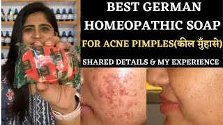 Best Homeopathic Soap For Acne Pimples And Boils || German Akne Sor Soap || #drarwabohra