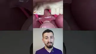 Cum &icirc;nlocuiești un dinte frontal FĂRĂ implant și FĂRĂ să șlefuiești dinții vecini 🦷✨