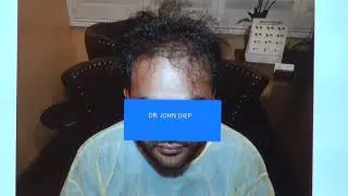 Frontal hair loss surgery treatment transformation update by Dr. Diep San Francisco, Ca