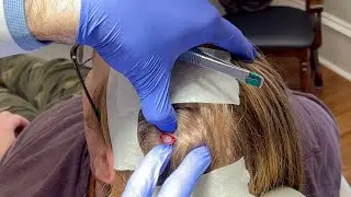 Large Pilar Cyst Removal and Popping