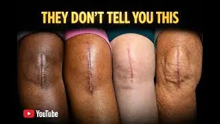 What They Don&rsquo;t Tell You About Total Knee Replacement | Real Patient Stories