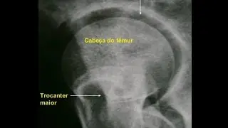 Raio X - Quadril Falso Perfil Lequesne