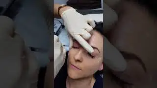 Anti Wrinkle Injections + Venus Freeze - Spring 2018 Special offer by AKINA