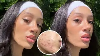 how i used to cover my acne (tips to cover pimples using drugstore makeup)