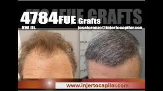 4784FUE Grafts. NW III. Refuerzo 5 a&ntilde;os despu&eacute;s. 1st WFI Workshop. Injertocapilar.com.1826/2016