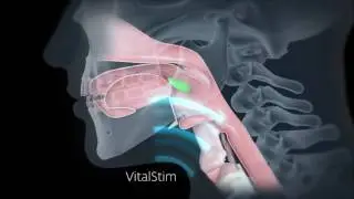 11 Chattanooga VitalStim