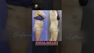 Total Sculpt Before and After Results | #bodysculpting #bodycontouring #shorts #youtubeshorts