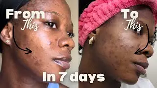 did this cleanser help my oily acne prone skin?! | one week update
