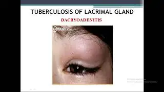A Class OCULAR MANIFESTATIONS OF TUBERCULOSIS By Dr Vivekanand Dept Of Ophthalmology