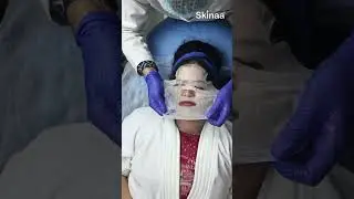 Best Carbon Laser Facial at Skinaa Clinic #Viral #shorts