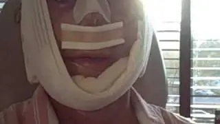 My Facial Plastic Surgery Blog - Recovery Day 2
