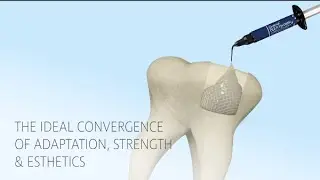 One-Step Bulk Filling - G-&aelig;nial&trade; BULK Injectable