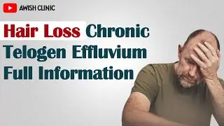 Chronic Telogen Effluvium | Hair Loss Ep-4| | By Dr. Vijay Kumar in Hindi