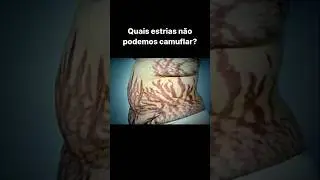 Se a sua estria n&atilde;o se encaixa nestes casos, ent&atilde;o voc&ecirc; pode fazer a #camuflagemdeestrias #estrias