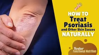 How To Treat Psoriasis and Other Skin Issues Naturally | Functional Nutrition with Dr. Bek