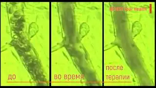Эффект БЕМЕР &ndash; кровообращение до и после терапии