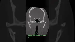 How I read CT Facial Bones #radiology #teleradiology