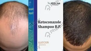 Best and cheapest sampoo ketoconazole in india for hairgrowth and dandruf #shampoo  #minoxidil #hair