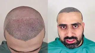 new journey begins - Hair Transplant review | Hair Transplant in Gurgaon 2026