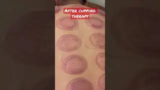 #after #cupping #therapy #hijama #shorts #youtubeshorts