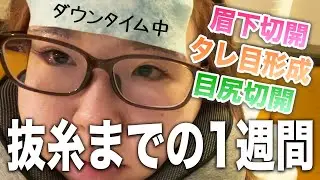 【整形後1週間レポ】眉下切開・目尻切開・タレ目形成やりましたーん【ダウンタイム】