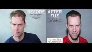Dr. Arocha- Corrective FUE 2043 Surgery- Before and After Pictures