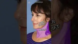 Turkey Neck ➡️ Snatched Jawline |  Lower Facelift + Neck Lift #beforeandafter #antiaging #cosmetic