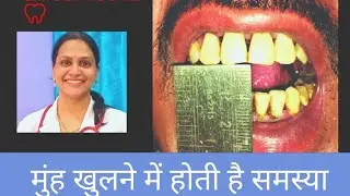 मुंह खुलने में होती है समस्या? OSMF का ईलाज | Mouth Opening Exercises | ये एक्सरसाइज करे