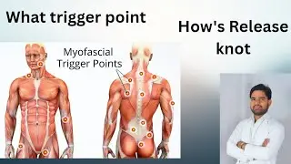 What is Trigger point or muscle knot.why pain create tightness of muscle #musclerecovery
