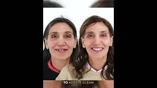 All-On-X Specs - Glenferrie Dental