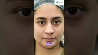 Before and After Dark Under Eye Treatment Using Hyaluronic Acid and Fillers | Dr. Ipshita Johri